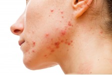 ACNE & SPOTS